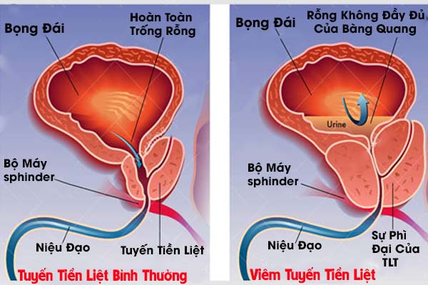 Biểu hiện bệnh viêm tuyến tiền liệt